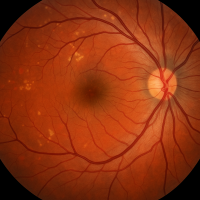 ¿Qué es la Retinopatía Diabética?